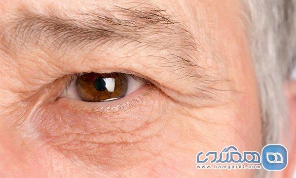 روش های درمان ورم اطراف چشم روش های درمان ورم اطراف چشم
