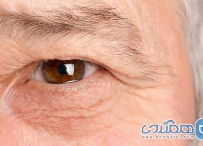 روش های درمان ورم اطراف چشم
