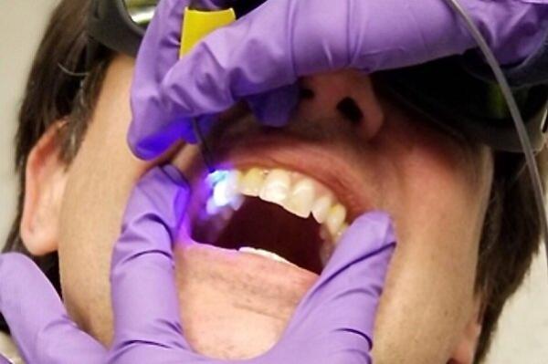 فراوری حسگر برای شناسایی دندان های در معرض خطر پوسیدگی